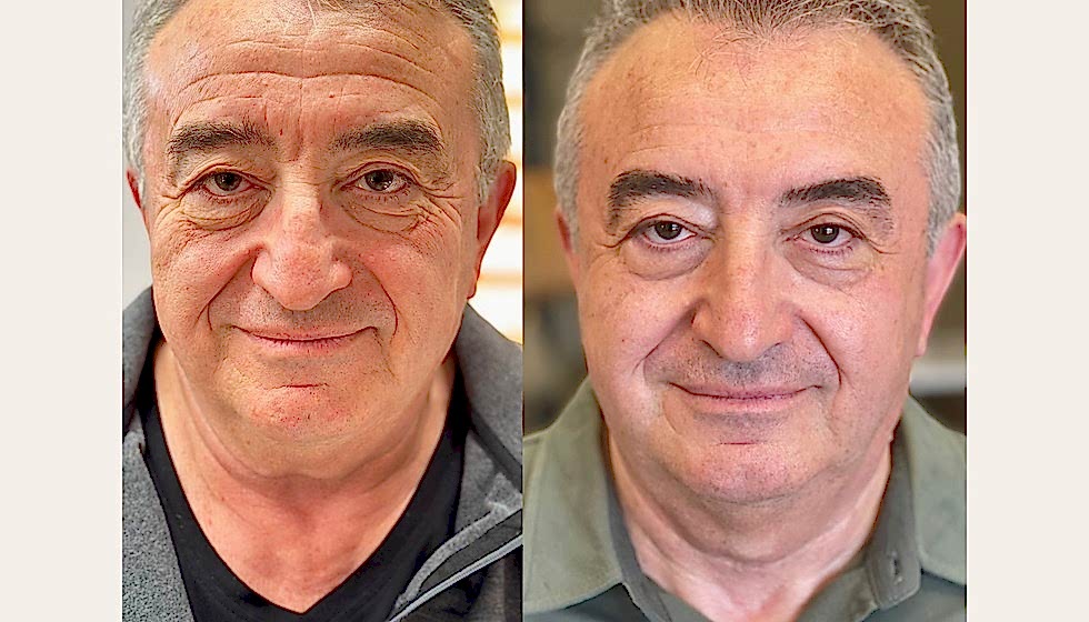 Bukkal masaj öncesi sonrası 6